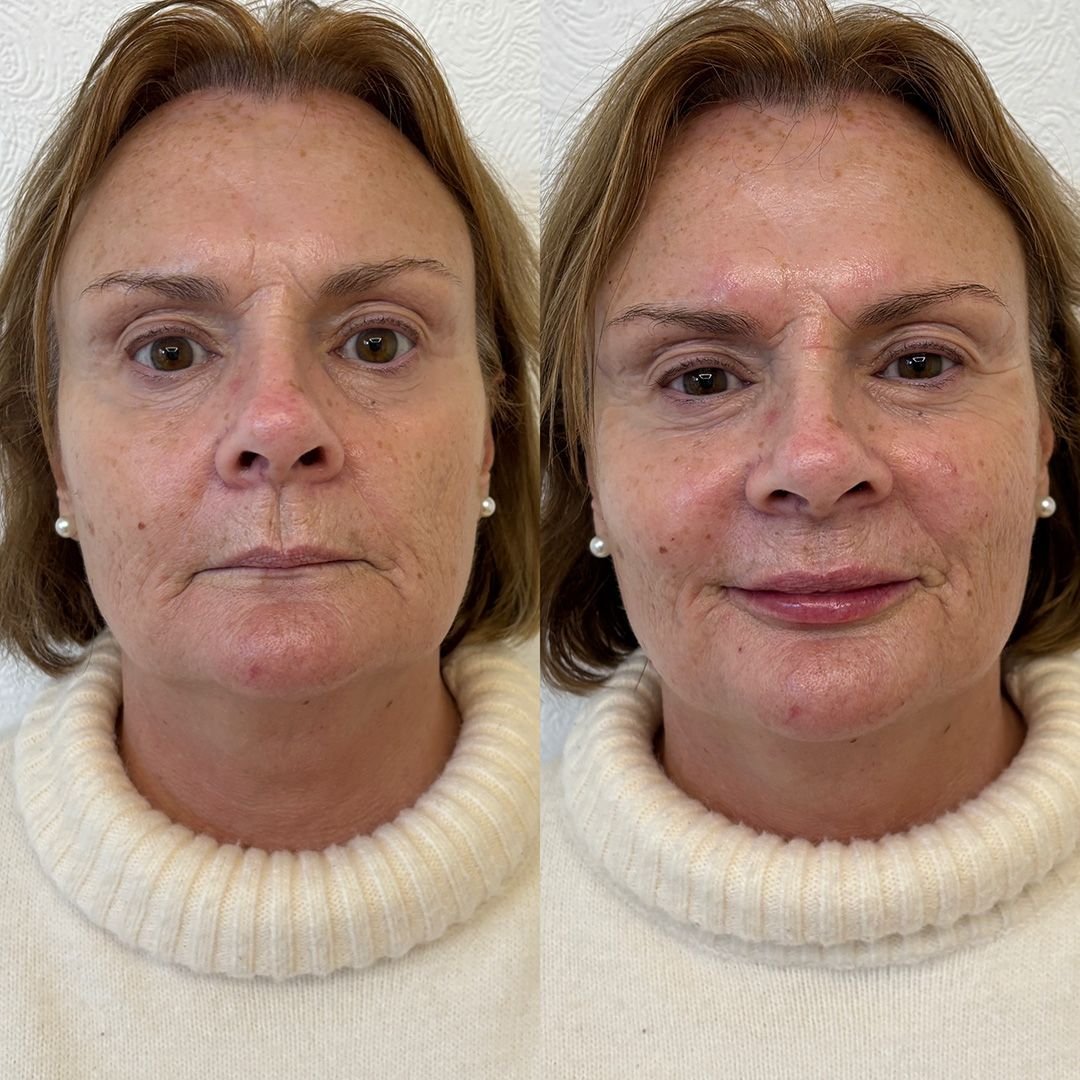 lips and cheek enhancement