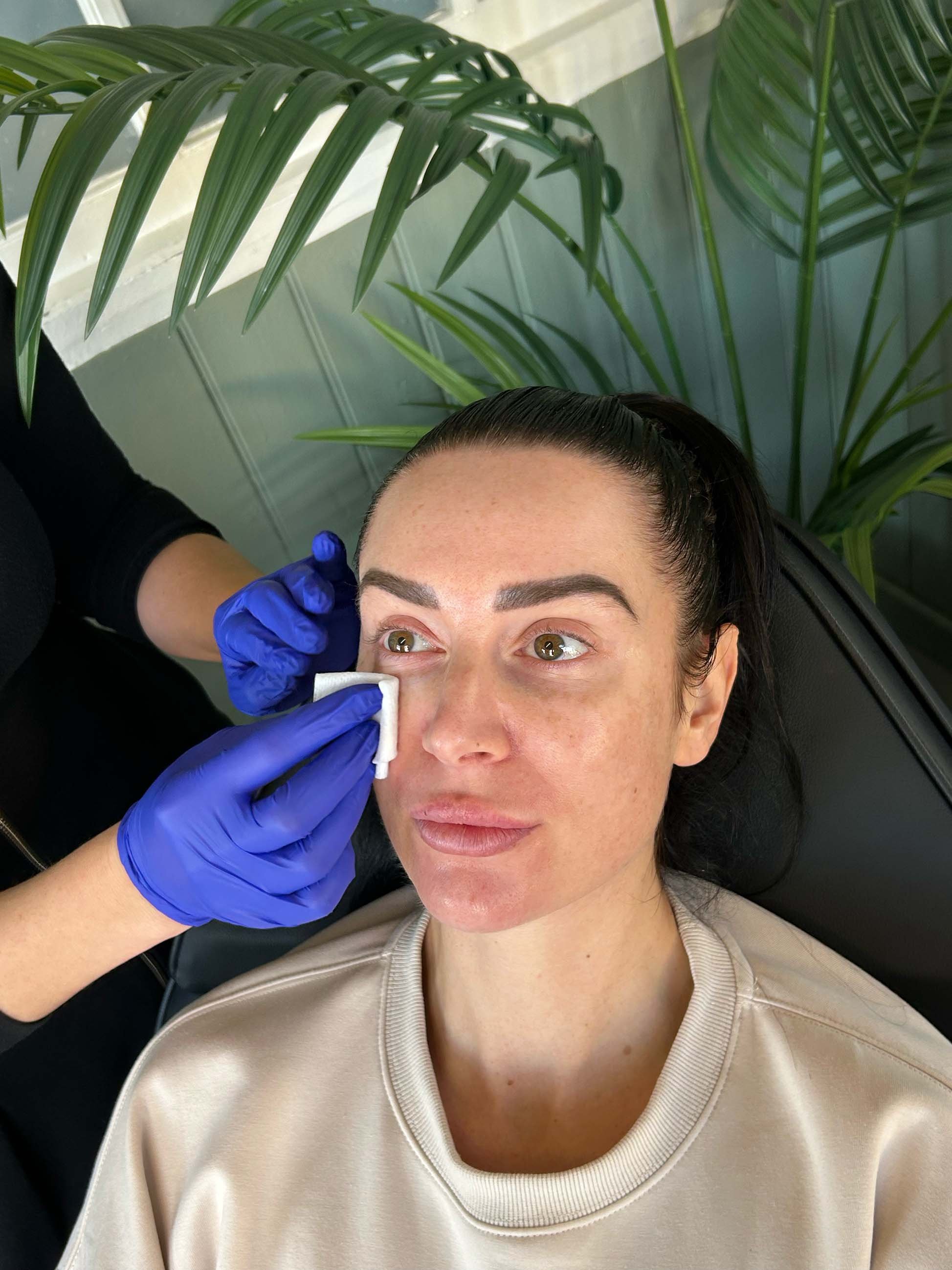 woman getting face wiped before botox treatment