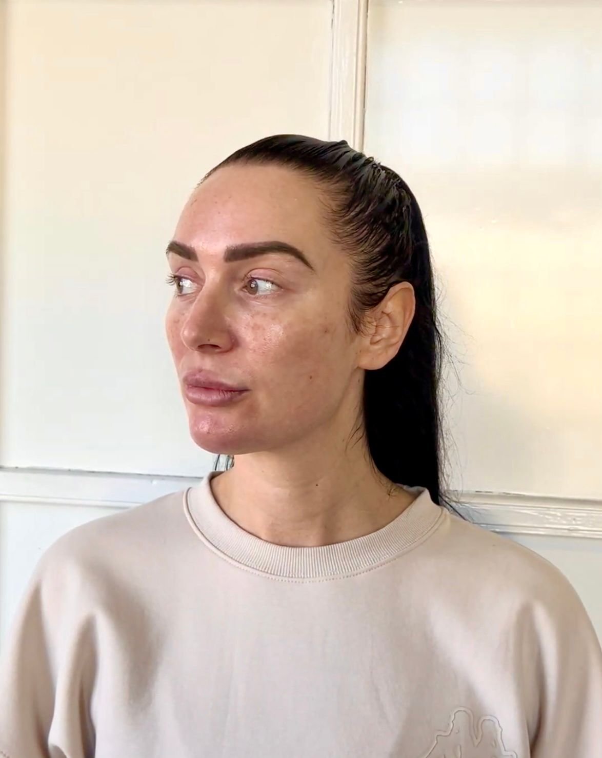 woman with dark hair after botox treatment