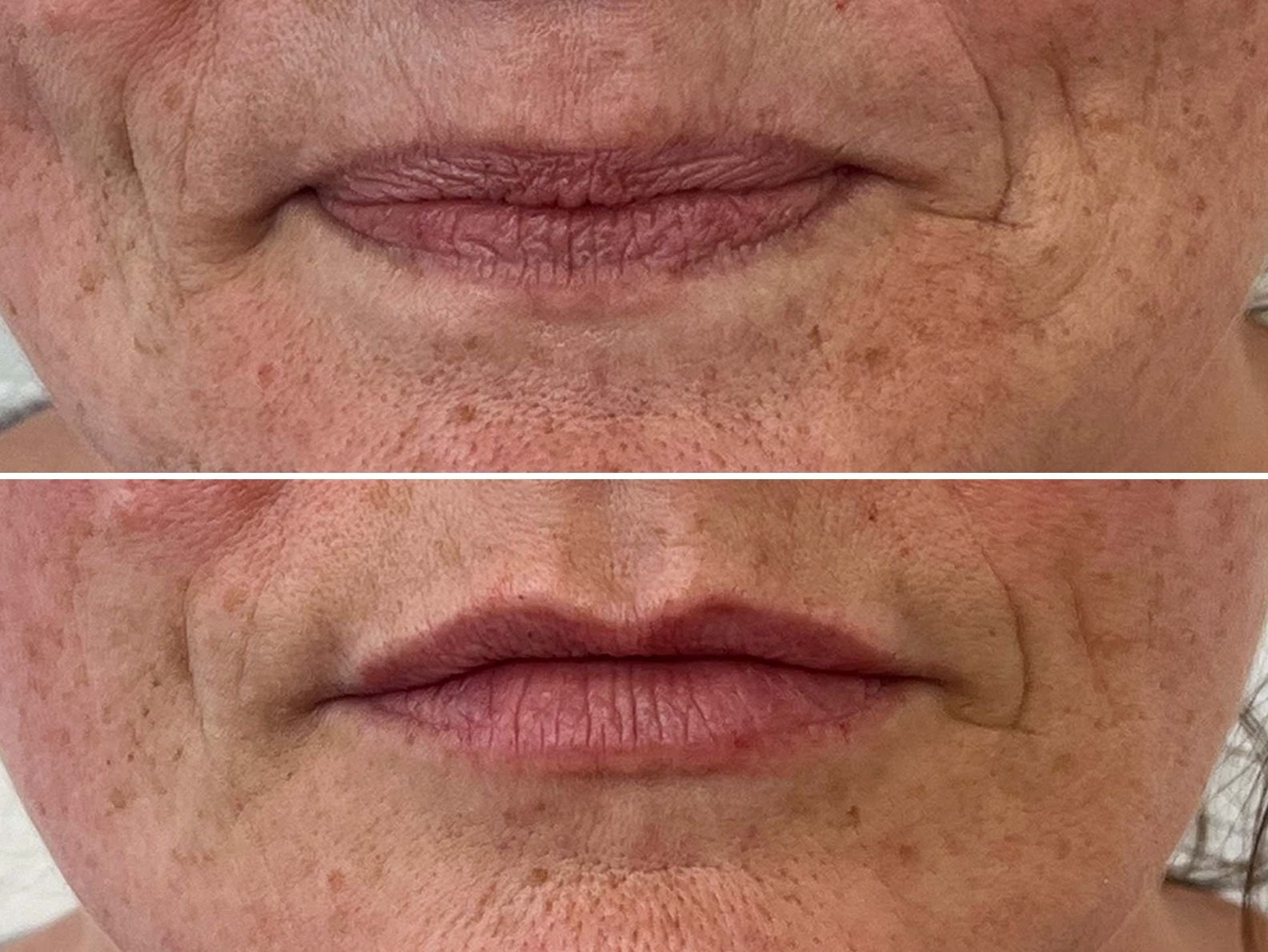 jodie lip filler results