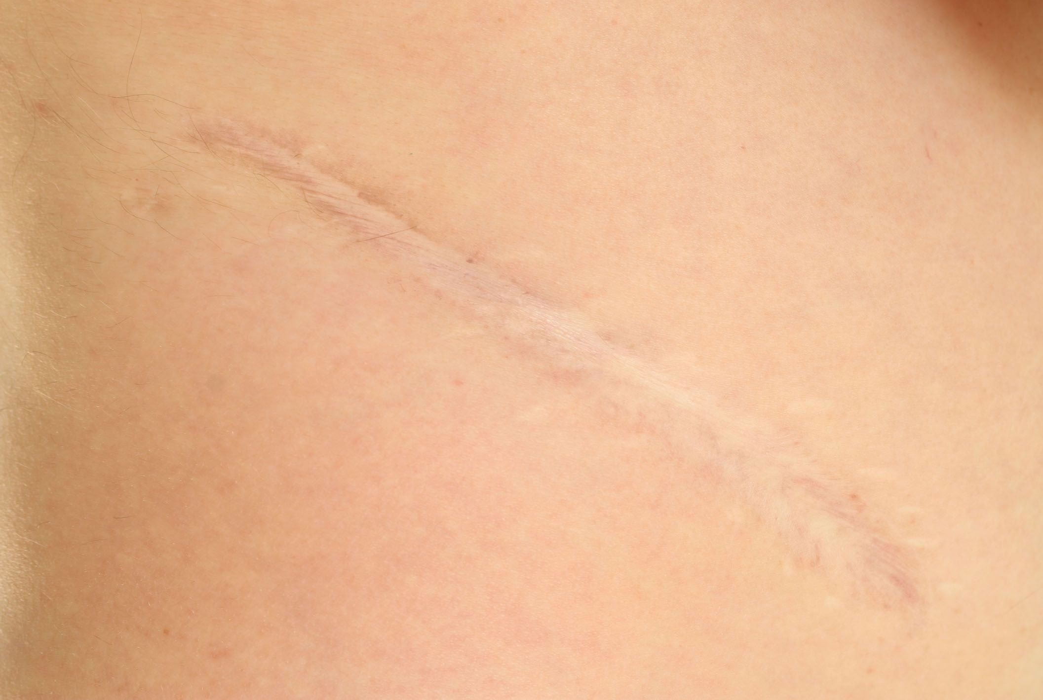 body scar up close