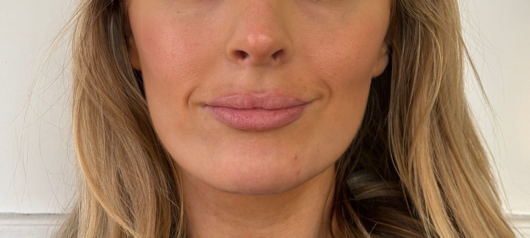 chin filler after