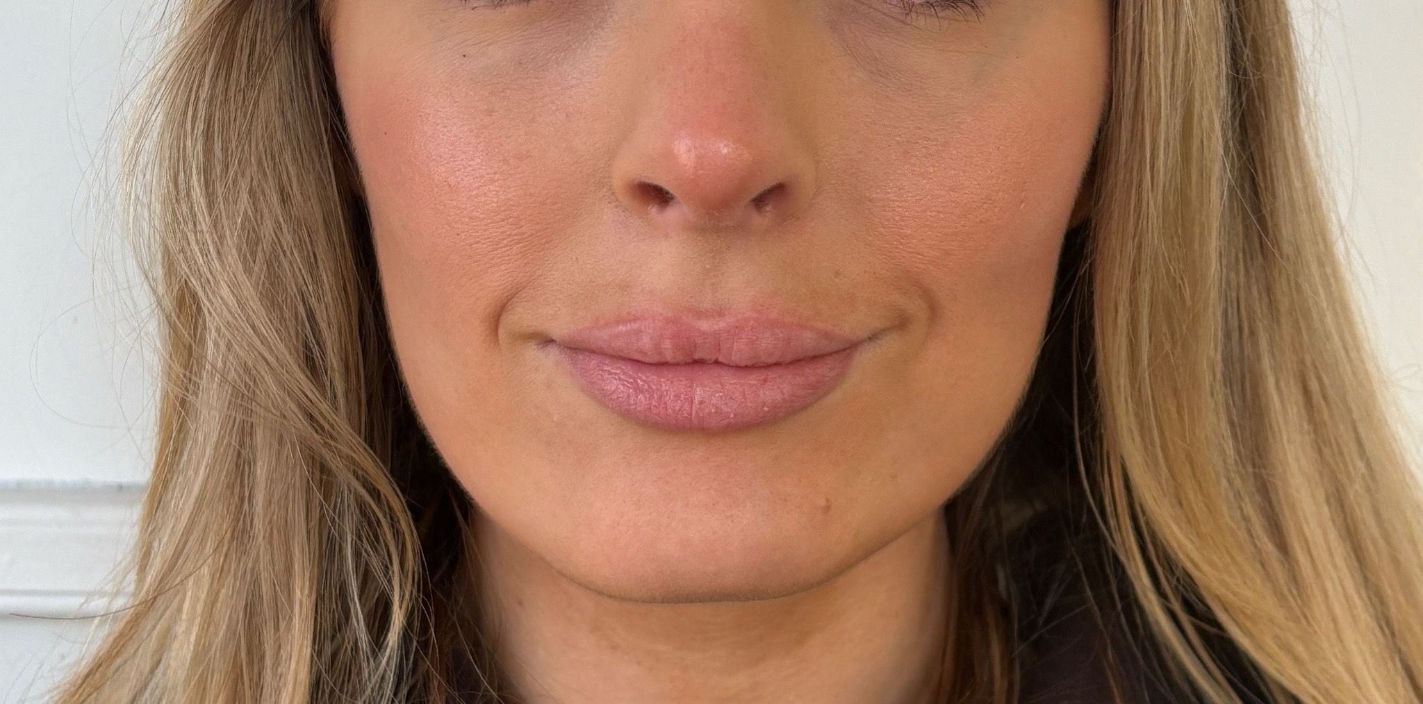 chin filler before