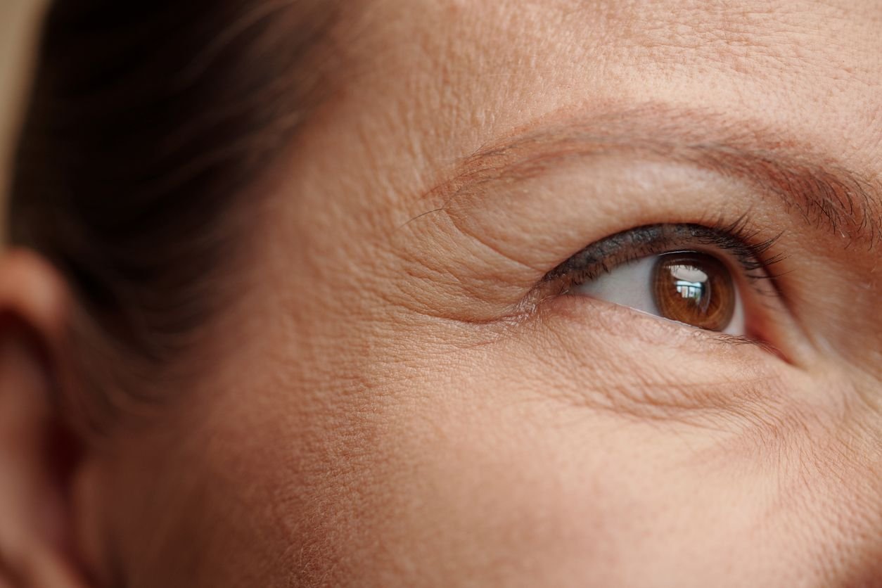 crows feet around eyes