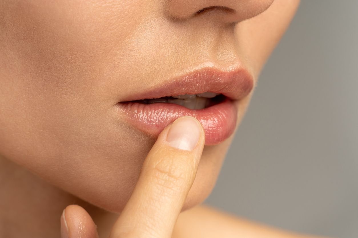 lip filler recovery