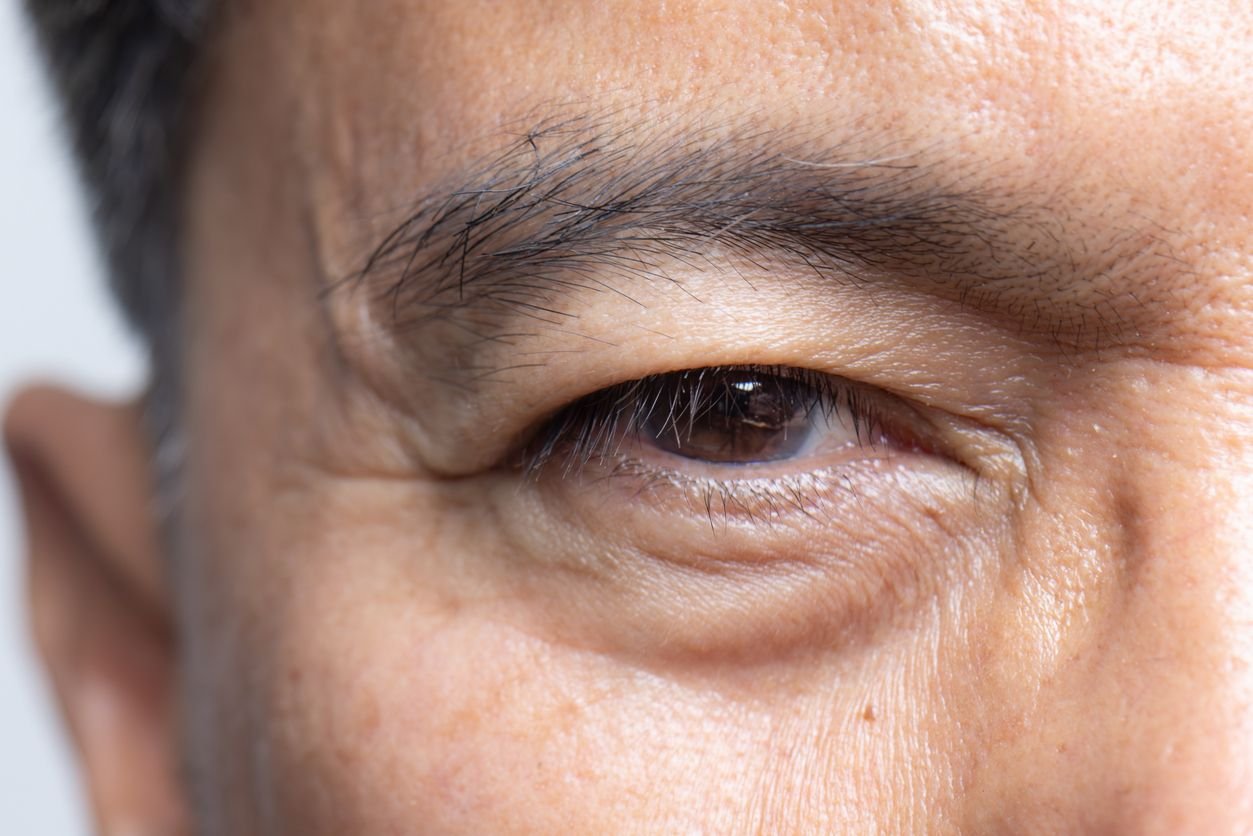 man with eye wrinkles