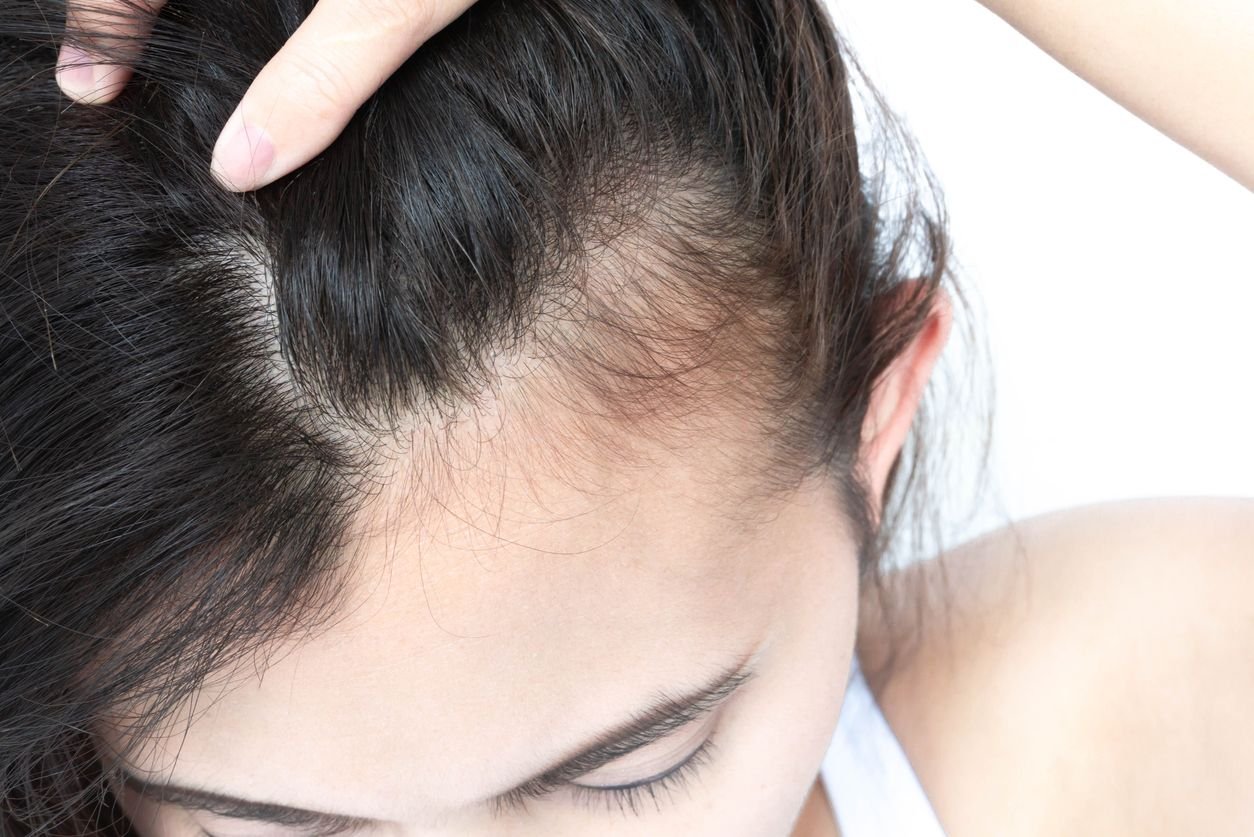prp hair loss woman