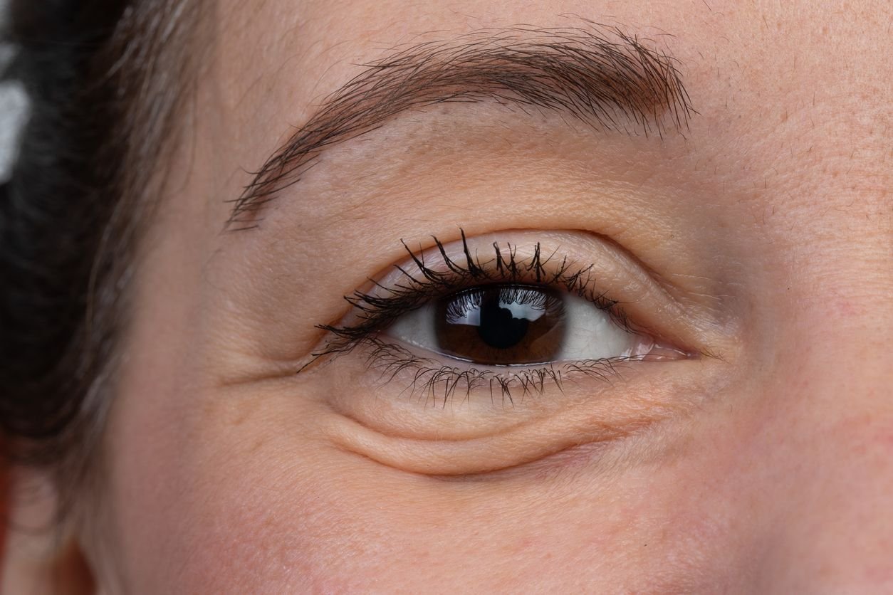 under eye wrinkles
